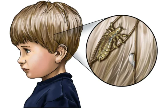 PIDOCCHI-COP-e1674060645844